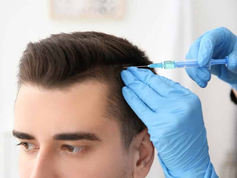 What you need to know about FUE Hair Transplant Procedure