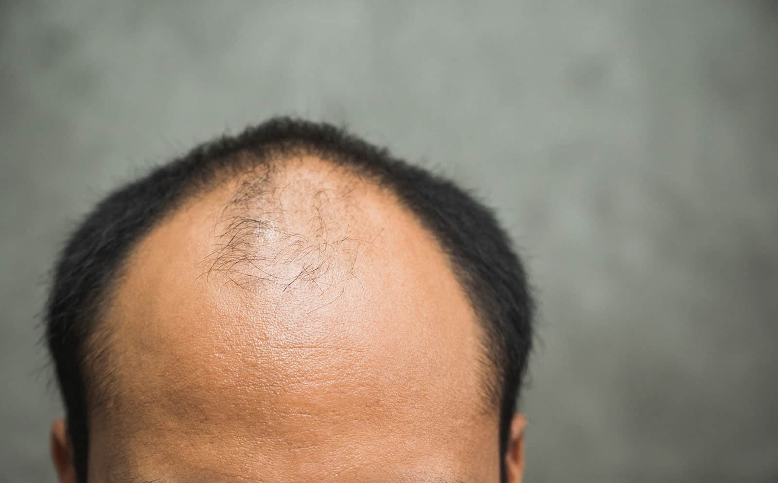 Are You Wondering Why Hair Transplant Procedure Is Expensive? Don’t Wonder Anymore With These 7 Reasons