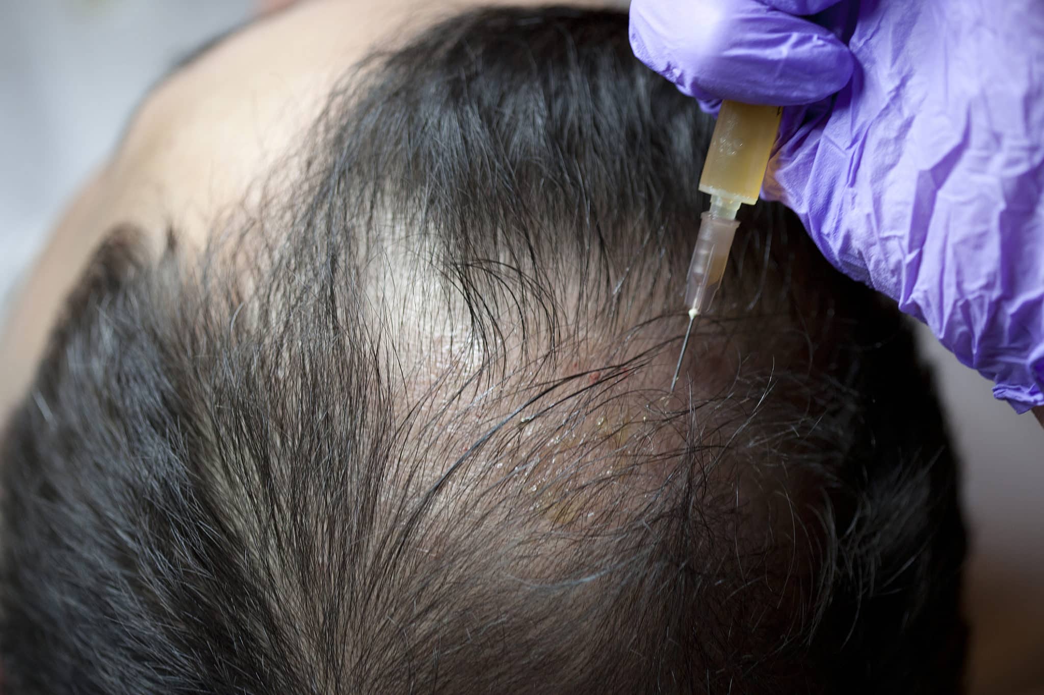PRP And Hair Transplant - How Are They Different?