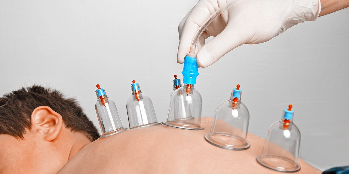 10 Benefits of cupping therapy