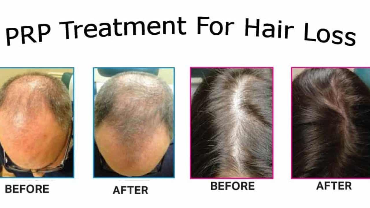 How Long Does PRP Last For Hair Loss And What Should I Expect From The Treatment?