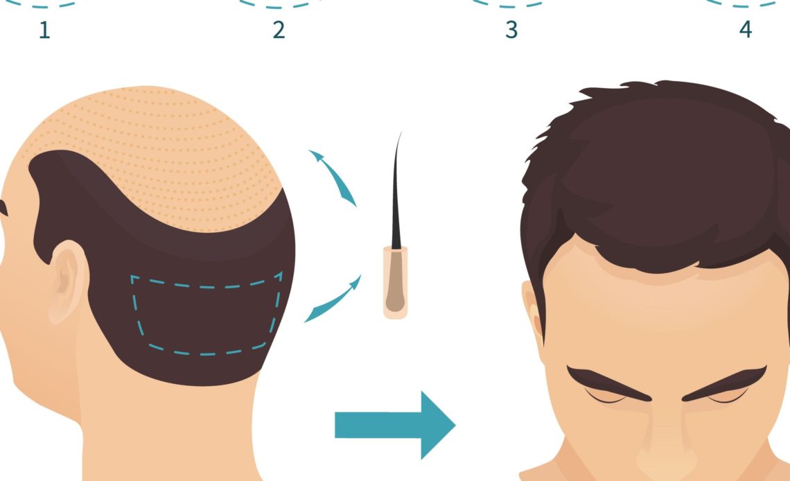 5000 grafts hair transplant cost in pakistan