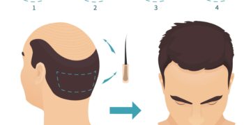 Everything You Need To Know About FUE Hair Transplant Cost in Pakistan