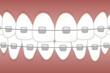 Critical Things You Must Know About Ceramic Dental Brackets