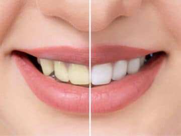 Teeth Whitening Ingredients Guide for Beauty Salons