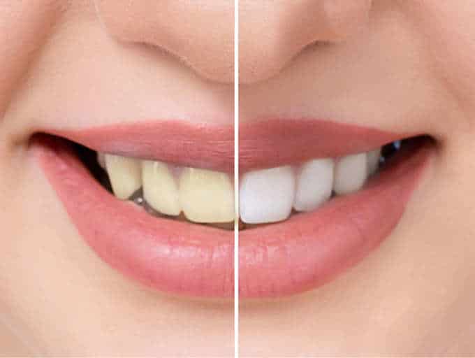 Teeth Whitening Ingredients