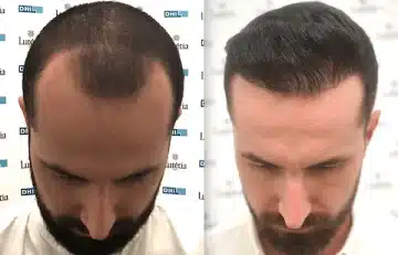 Unlocking the Secrets of Hair Transplant in Dubai: Your Path to Confidence and Beauty
