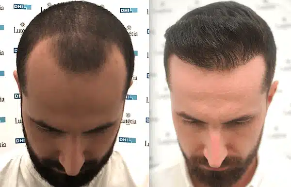 Hair Transplant in Dubai